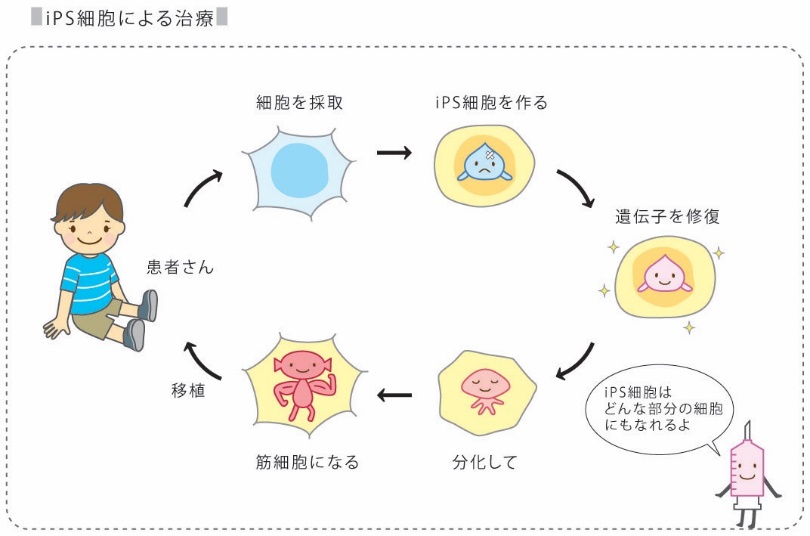 iPS細胞による治療の説明図